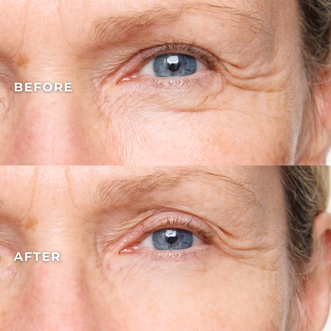 Wunderbrow  Wunderlift 60 Second Wrinkle Reducer