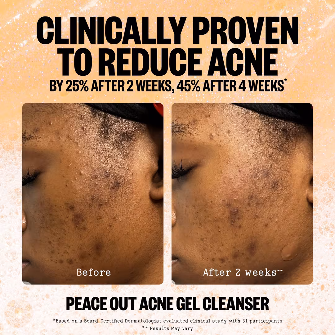 Peace Out  2% Salicylic Acid Acne Gel Cleanser