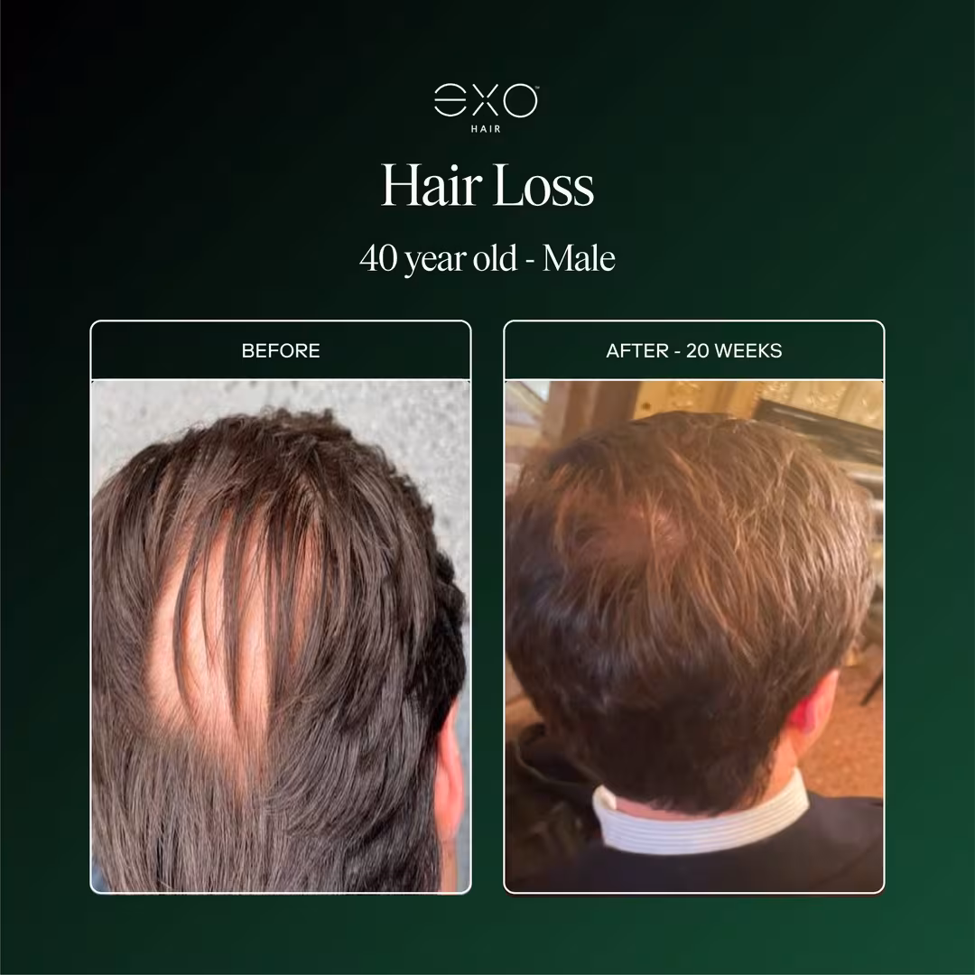 Exoceuticals  EXO ACTIVATE Follicle Enrichment Serum