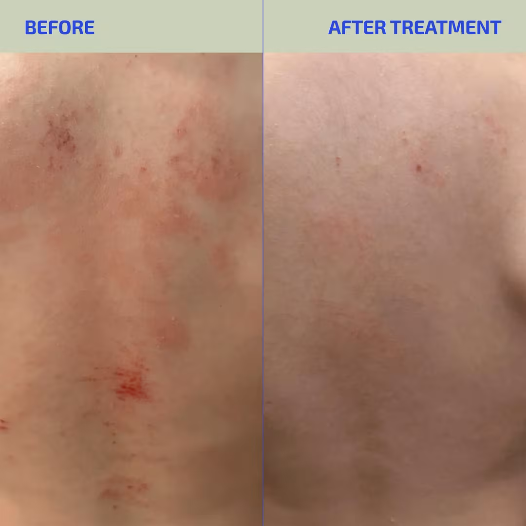 Codex Labs  BIA ClearSkin Synbiotic Supplement for Eczema-Prone Skin