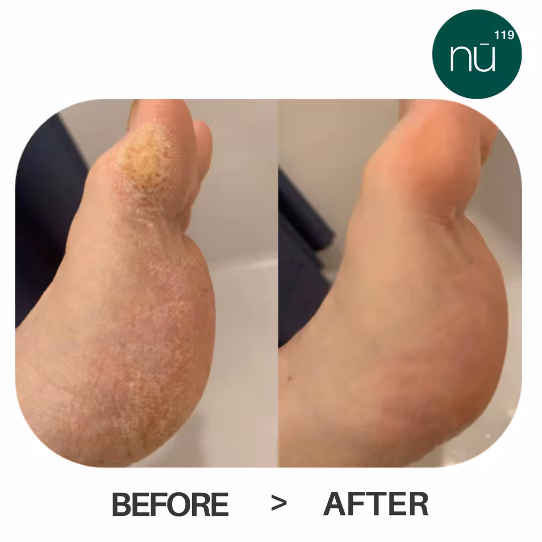 nu119  Platinum Peel (Starter Kit w/ Foot File)