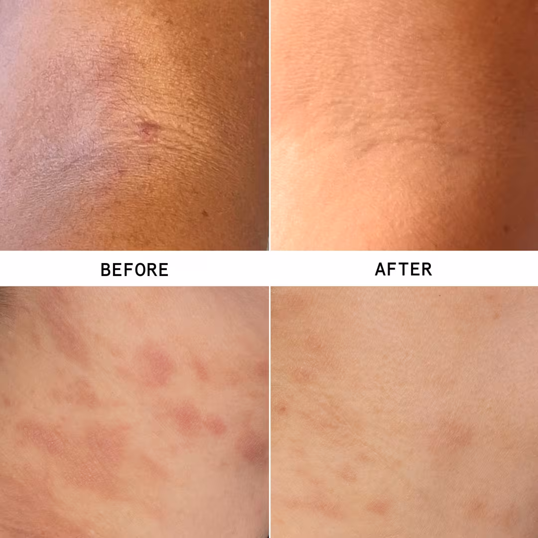 Hypothesis  Eczema Discovery Kit
