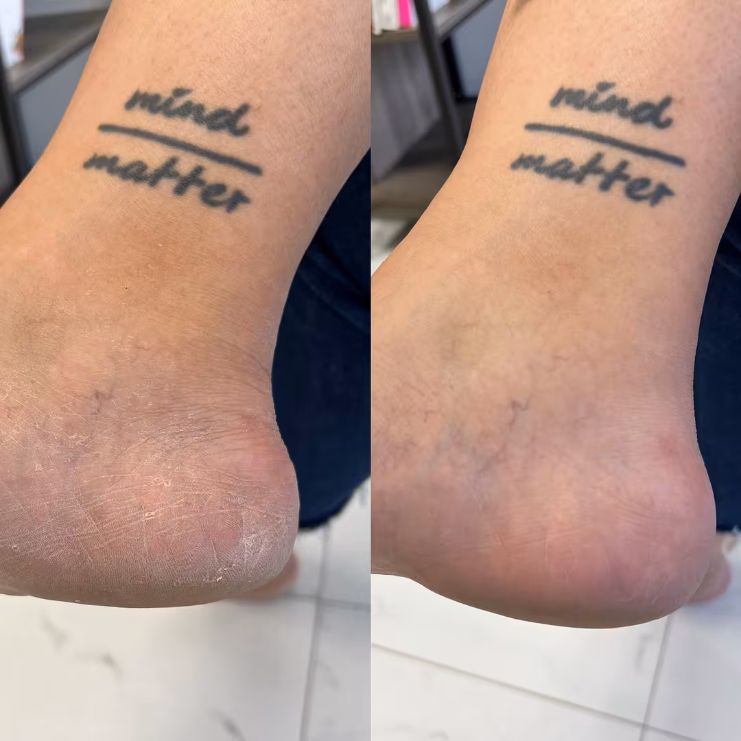 nu119  Platinum Peel