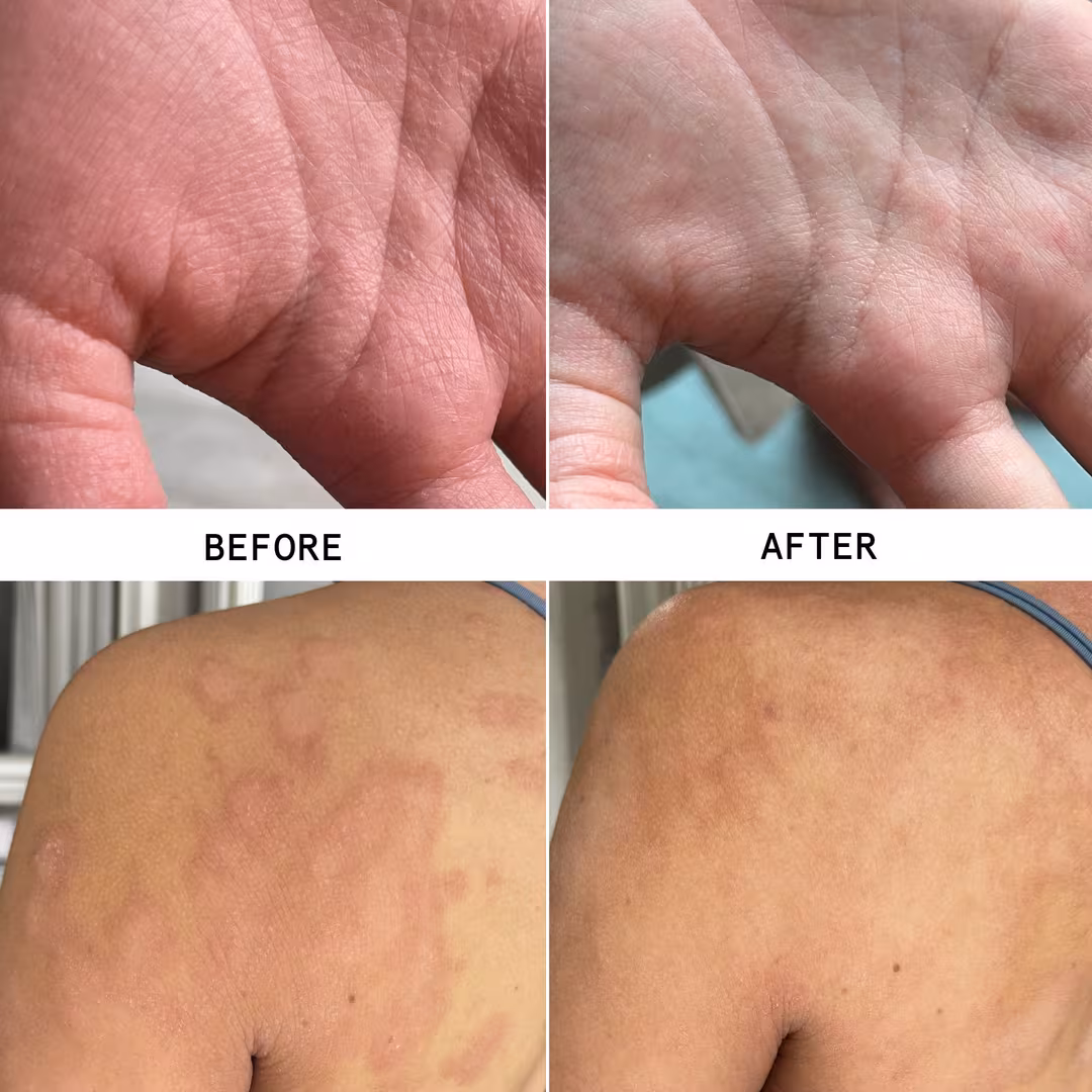 Hypothesis  Eczema Soothe + Repair Duo