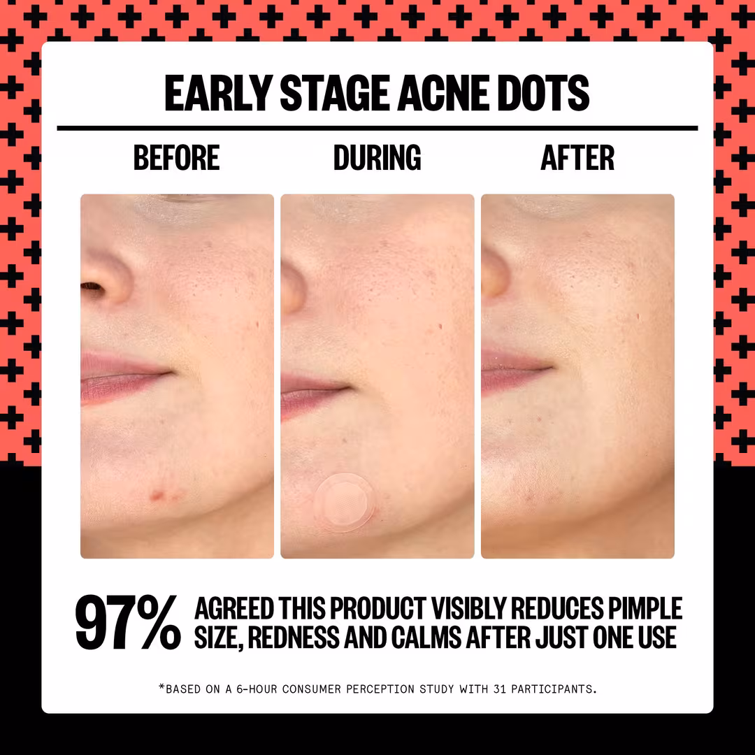 Peace Out  2% Salicylic Acid Early Stage Acne Dot