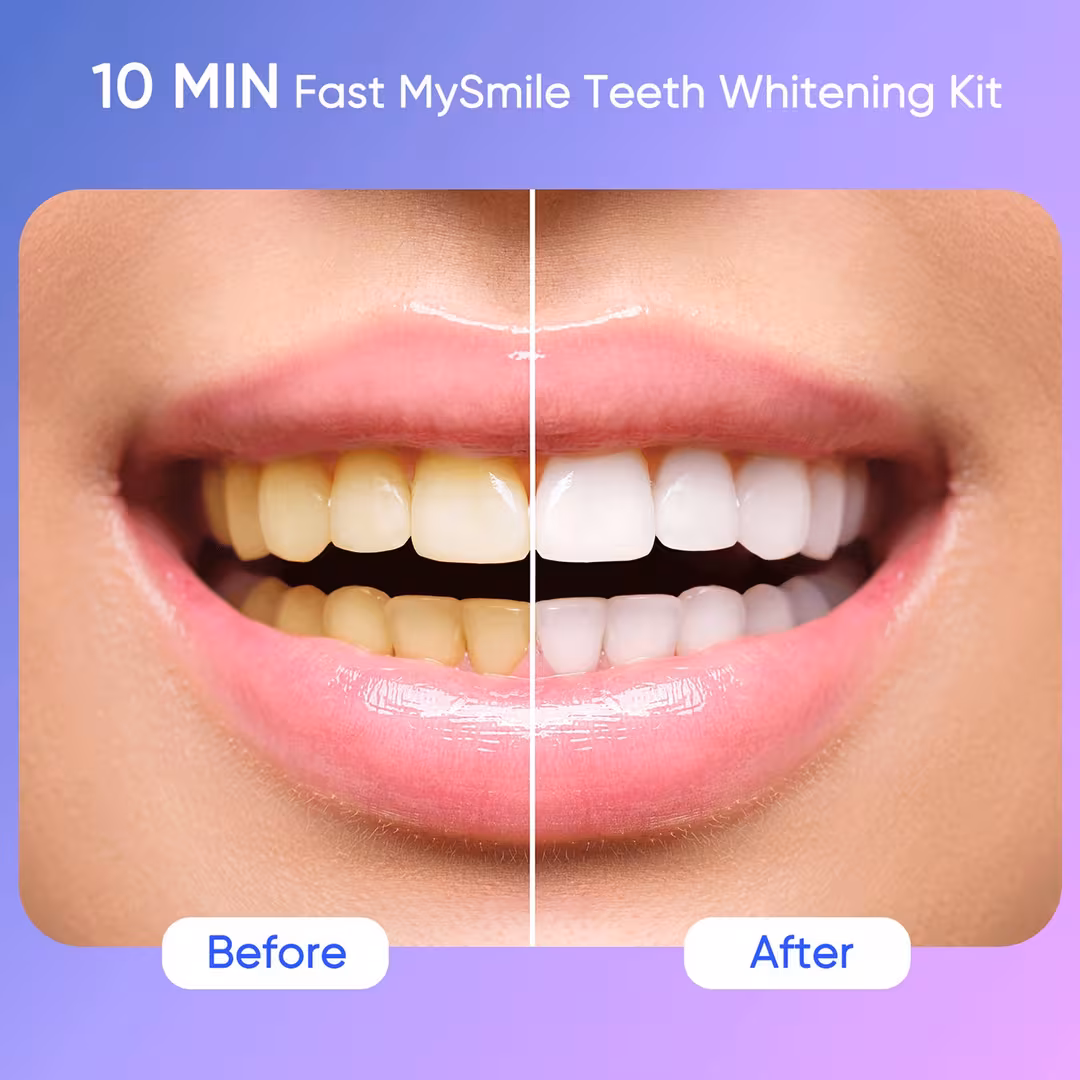 MySmile  Ultimate Teeth Whitening Kit with Enamel Strengthening Gel
