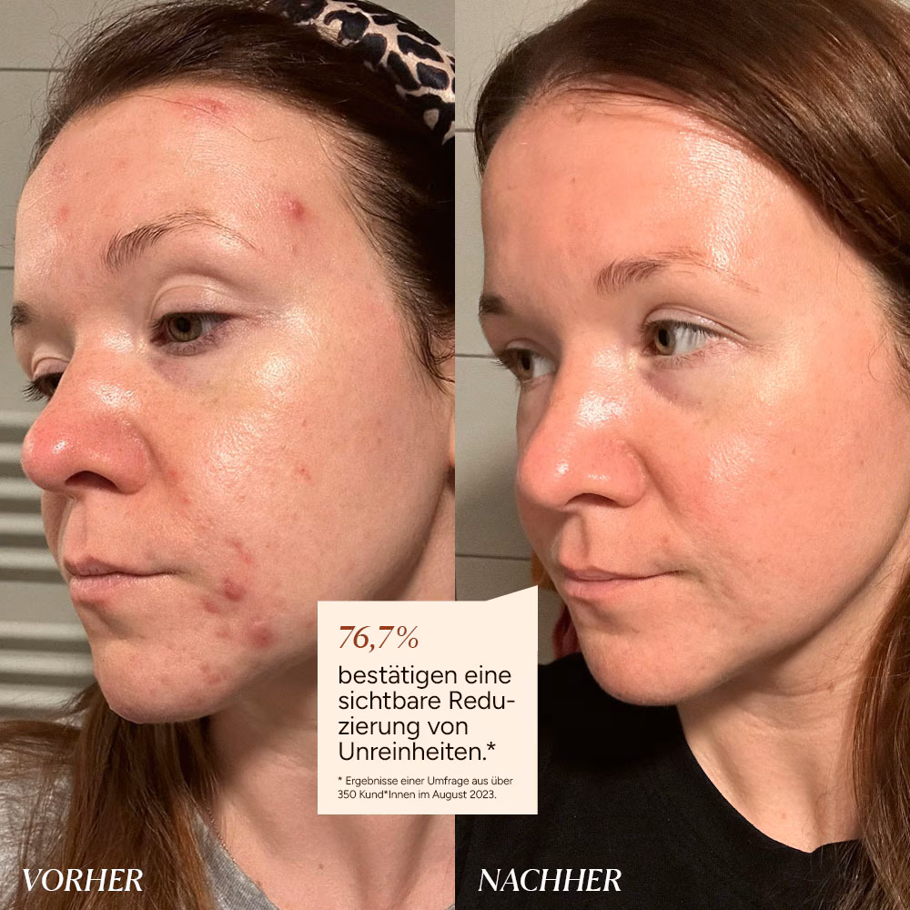 Azelain Serum