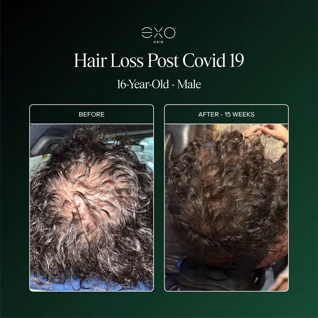 Exoceuticals  EXO FORTIFY Revitalizing Hair & Scalp Treatment