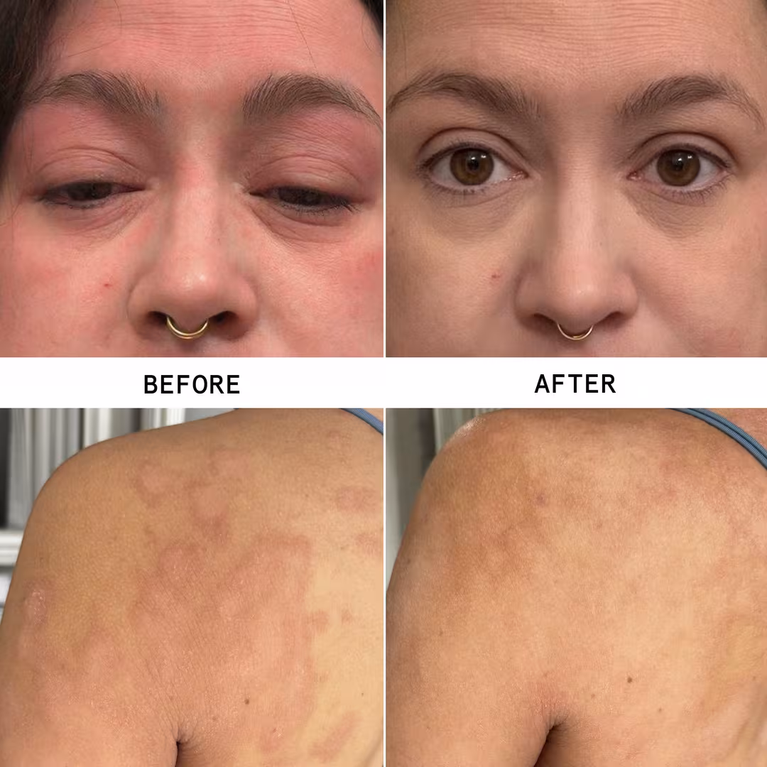 Hypothesis  Complete Eczema Care Set