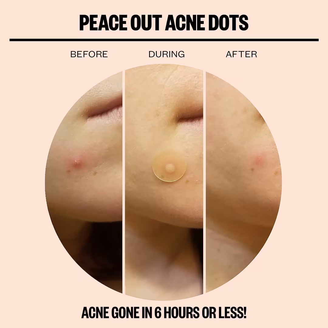 Peace Out  Salicylic Acid Acne Healing Dots