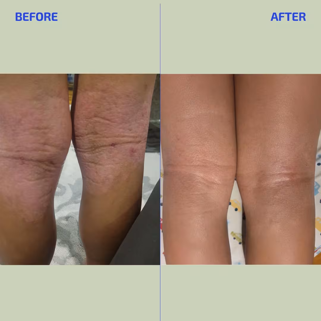 Codex Labs  Bia Eczema Relief Lotion
