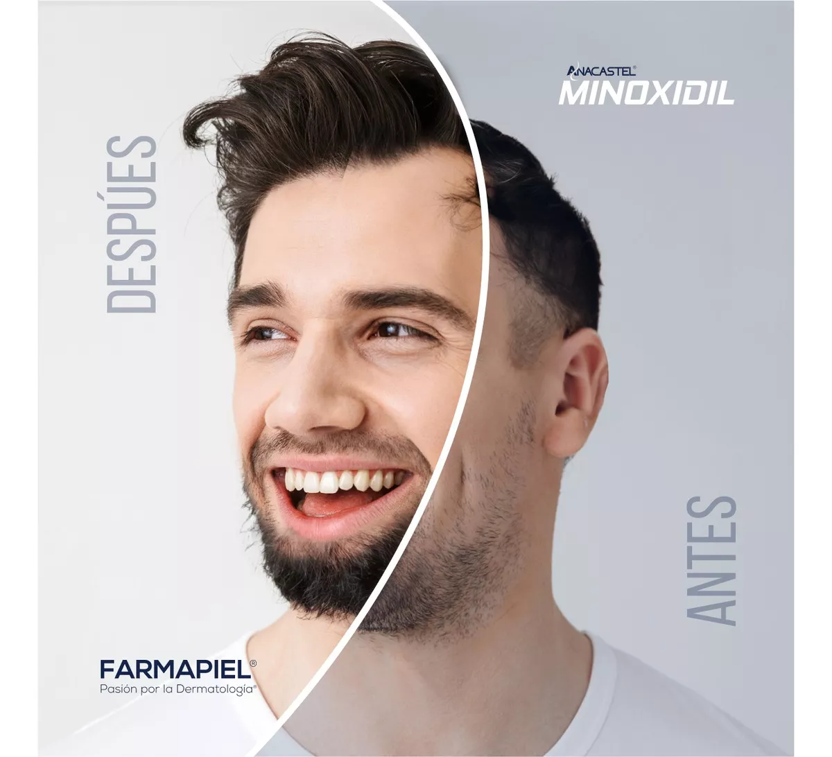 2 Piezas Minoxidil 5% Spray Anacastel Cabello Y Barba 60 Ml