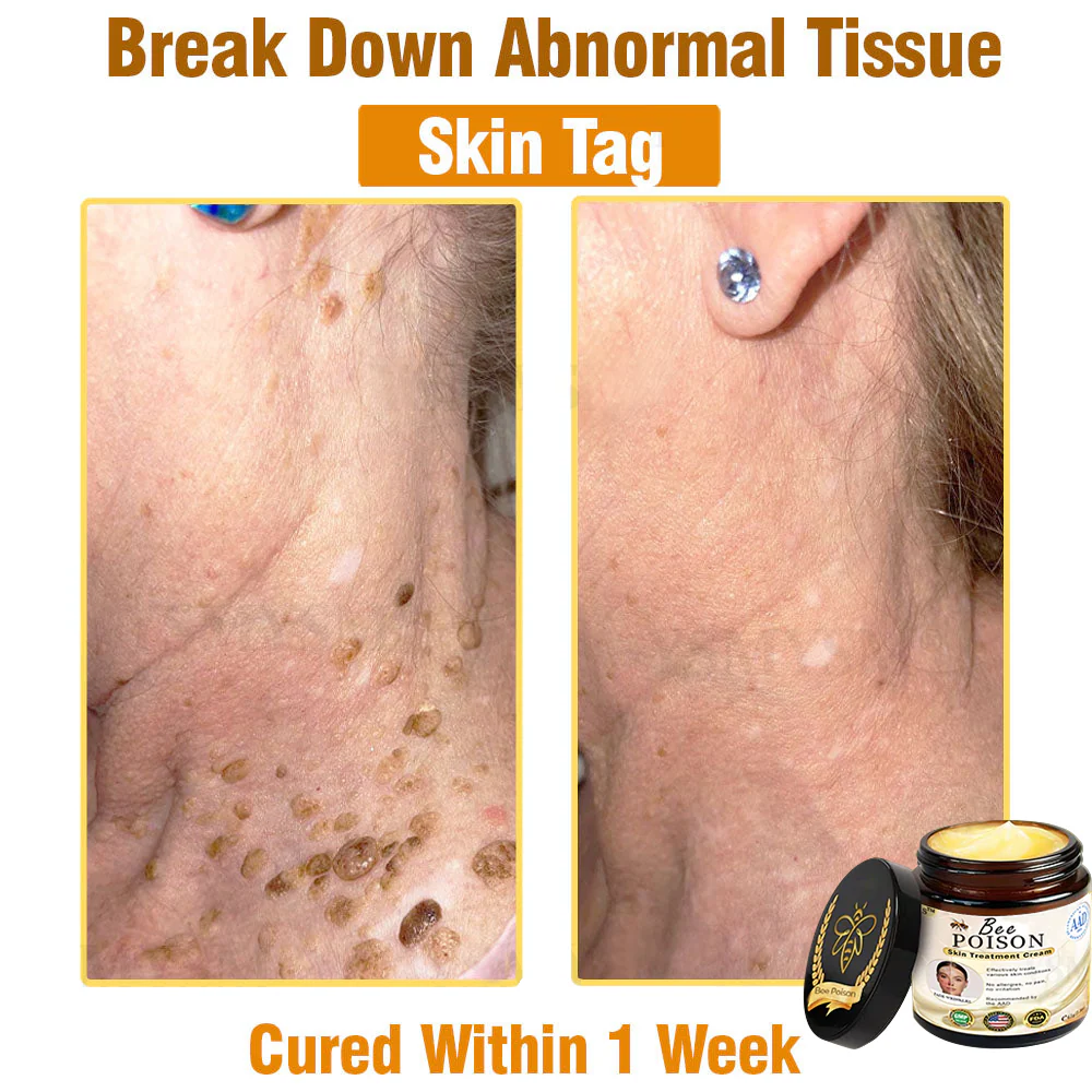 [Official Store] LOVILDS™ Full-Body Repair Cream: Anti-Aging, Hydration, Skin Repair, Even Tone, Acne & Dark Spot Treatment, Wart & Mole Removal, Psoriasis Relief