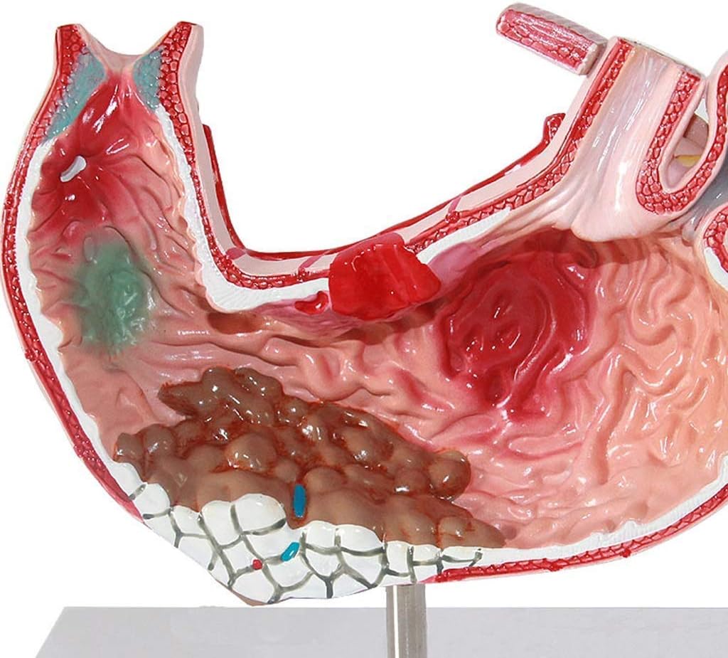 Skeleton Model Human Organ Anatomical - Human Stomach Anatomical Model- Gastritis Model Gastric Lesion Model- Gastric Pathology Gastritis Ulcer Medical Teaching Aid for Medical