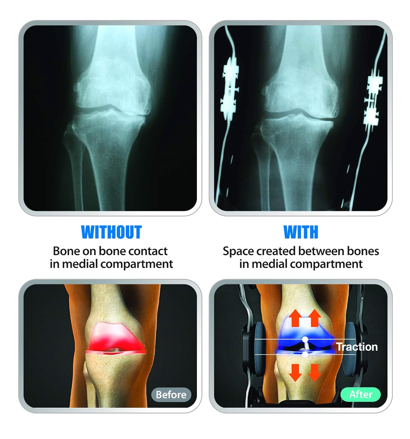 DDS, Inc. OA Pro Decompression Knee Braces - Arthritis Knee Support for Degeneration, Meniscus Tear, Bone-on-Bone Pressure Relief - Dual Unloading for Medial & Lateral Stability (Large)