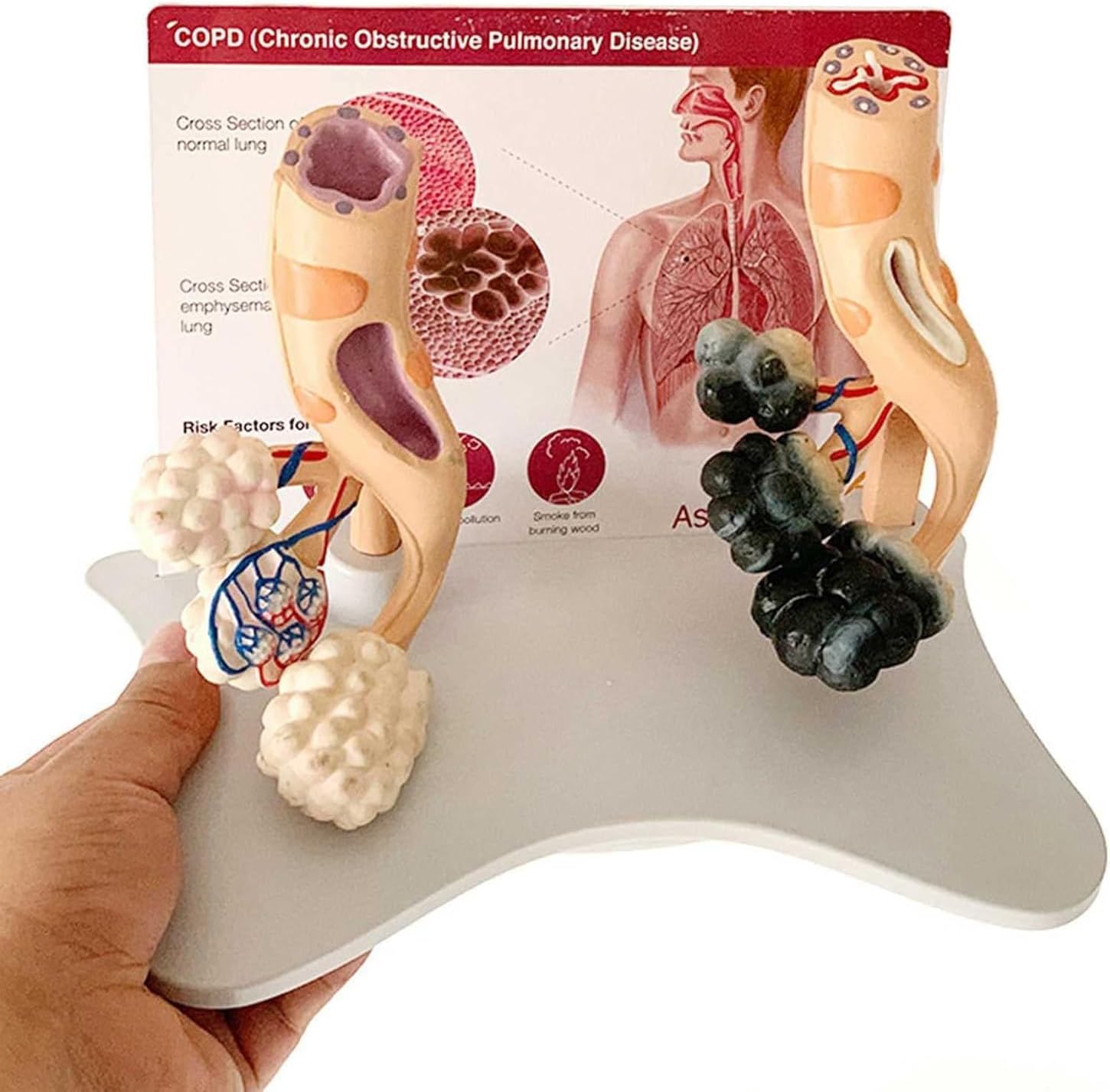 Human Alveolar Anatomical Model, Smoking Alveoli and Healthy Alveoli Comparison Model, Enlarged Alveolar Structure Model, with English Back Card, for Health Teaching