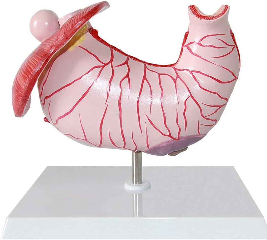 Human Organ Anatomy Model - Human Stomach Anatal Model- Gastritis Model Gastric Lesion Model- Gastric Pathology Gastritis Medical Training Aid