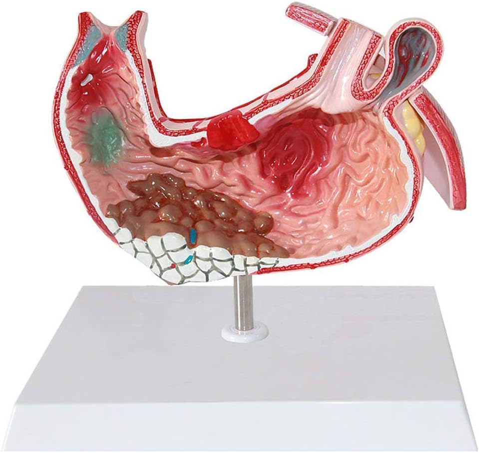 Human Organ Anatomy Model - Human Stomach Anatal Model- Gastritis Model Gastric Lesion Model- Gastric Pathology Gastritis Medical Training Aid