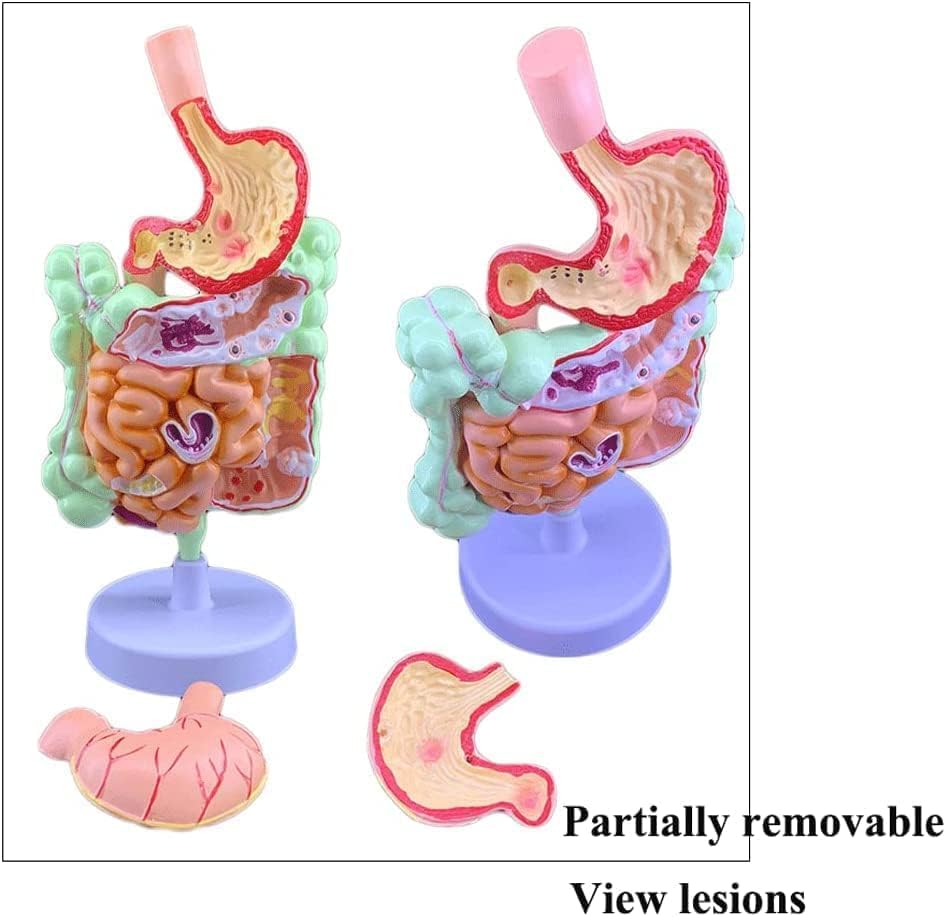 Large Intestine Pathological Model Pathological Anatomy Teaching Model Human Organ Model for Teaching Study Class Students